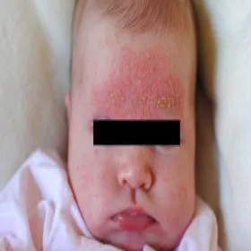 łojotokowe zapalenie skóry u niemowląt zdjęcie