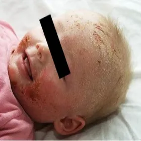 łojotokowe zapalenie skóry u niemowląt