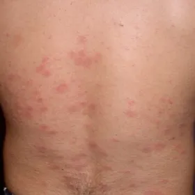 łupież różowy giberta zdjęcia