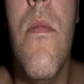 łuszcząca się skóra na brodzie