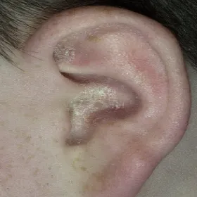 łuszcząca się skóra w uchu