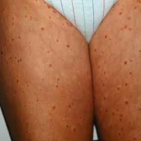 łuszczyca kropelkowata na nogach zdjęcia