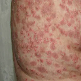 łuszczyca krostkowa