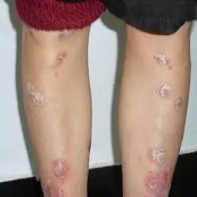 łuszczyca skóry nóg