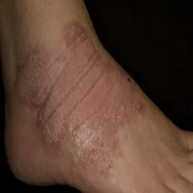 łuszczyca skóry stopy