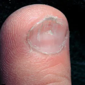 łyżeczkowate paznokcie