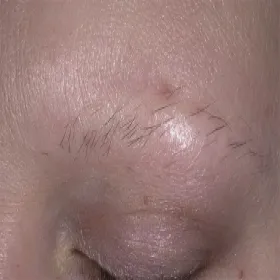 łysienie plackowate brwi