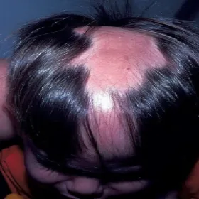 łysienie plackowate na czubku głowy u dziecka