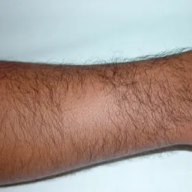 łysienie plackowate na rękach