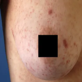 Świerzb na piersi u kobiety