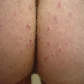 Świerzb na pośladkach