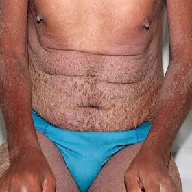 Świerzb norweski u mężczyzny