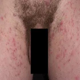 Świerzb okolic intymnych u mężczyzny