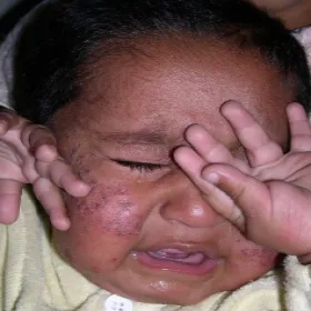 Świerzb u dziecka objawy