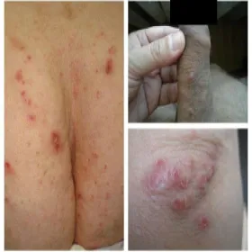 Świerzb wysypka grudkowa