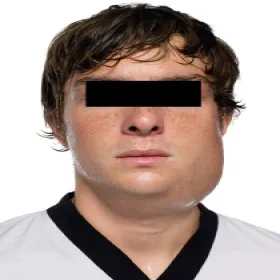 Świnka u młodzieży