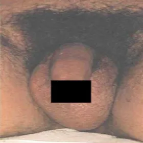 Świnkowe zapalenie jąder