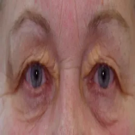 Żółta narośl na oku żółtaki 