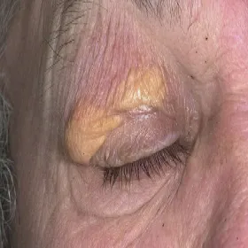 Żółta narośl na powiece kępki żółte 