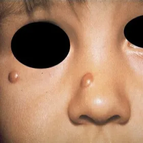 Żółtakoziarniniakowatość młodzieńcza u dziecka