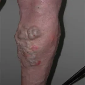 Żylaki wewnętrzne na nogach