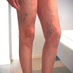 żylaki na nogach zdjęcie