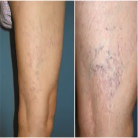 żylaki pajączki na nogach