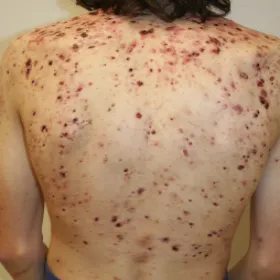 Acne fulminans 