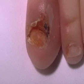 Acrodermatitis enteropathica zdjęcie