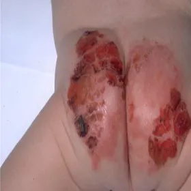 Acrodermatitis enteropathica