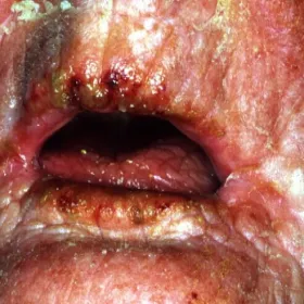 Alergia na leki objawy