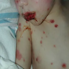 Alergia polekowa u dzieci zespół Stevensa- Johnsona