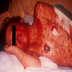 Alergia polekowa zespół Stevensa- Johnsona