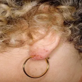 Alergiczne kontaktowe zapalenie skóry na złoto