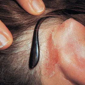 Alergiczne kontaktowe zapalenie skóry od okularów