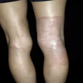 Alergiczne kontaktowe zapalenie skóry wywołane barwnikami