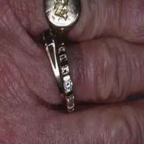 Alergiczne kontaktowe zapalenie skóry wywołane przez kontakt z metalami