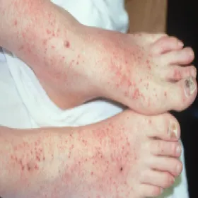 Alergiczne zapalenie naczyń objawy