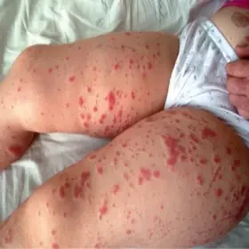 Alergiczne zapalenie naczyń u dziecka