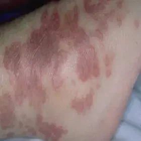 Alergiczne zapalenie naczyń zdjęcie