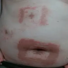 Alergiczne kontaktowe zapalenie skóry wywołane przez przylepiec