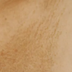 Amyloidozy skóry zdjęcie