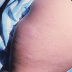 Anetoderma Pellizariego