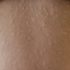 Anetoderma klasyczna Jadassohna 