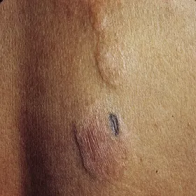 Anetoderma zanik plamisty skóry