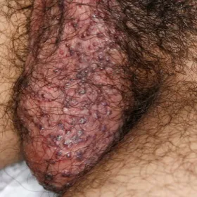 Angiokeratoma moszny