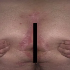 Atopowe zapalenie skóry między pośladkami