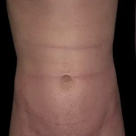 Atopowe zapalenie skóry na brzuchu