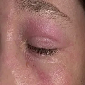 Atopowe zapalenie skóry oka