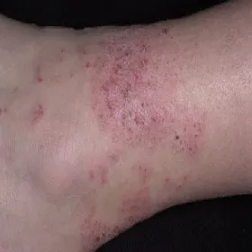 Atopowe zapalenie skóry u dorosłych